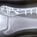 足首骨折にて手術～プレート固定