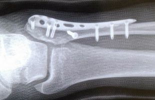 足首骨折にて手術～プレート固定